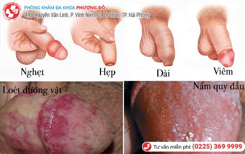 ngứa dương vật