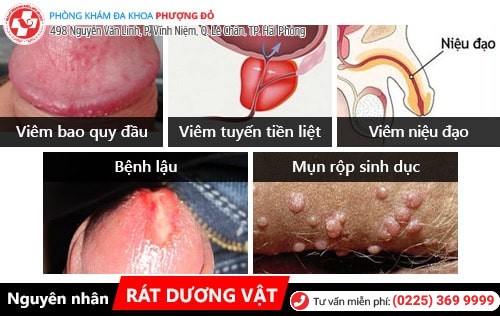 Nguyên nhân rát dương vật