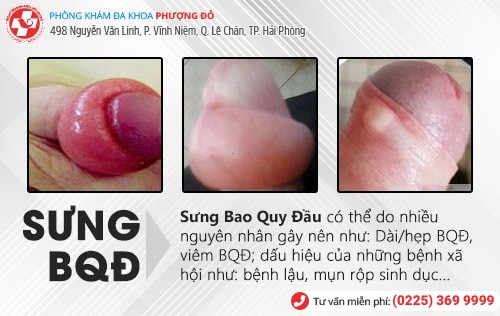 Sưng bao quy đầu là bị bệnh gì? Có nguy hiểm không?