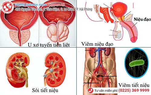 nguyên nhân viêm đường tiểu ở nam