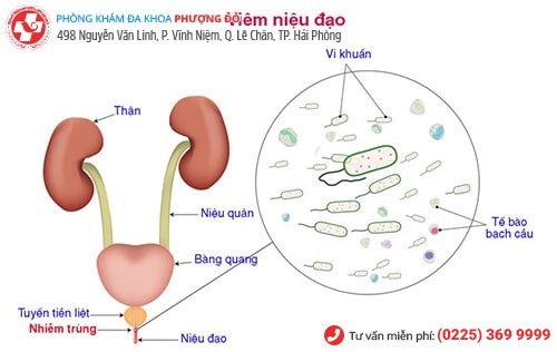 Viêm niệu đạo do nhiều nguyên nhân gây nên