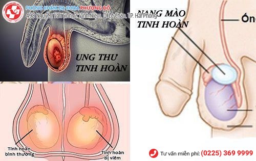 Nguyên nhân nhức tinh hoàn, nhức mào tinh hoàn