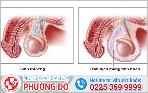 tràn dịch màng tinh hoàn