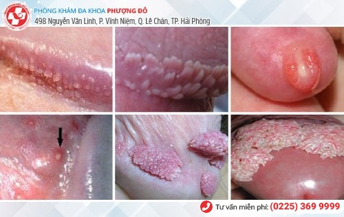 Nổi mụn bao quy đầu, kiểm tra ngay xem bạn đang mắc bệnh gì