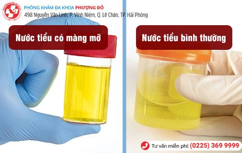 Nước tiểu có màng mỡ, váng mỡ