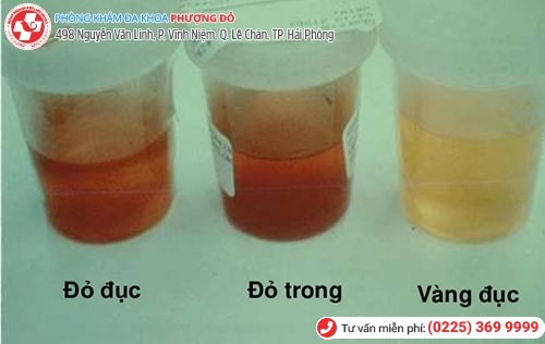 Đi tiểu ra nước có màu đỏ gây ra nhiều biến chứng nguy hiểm