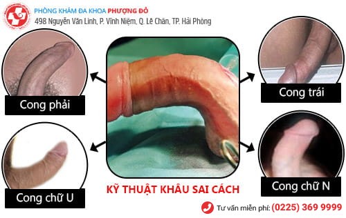 Ở Hải Phòng nên cắt bao quy đầu ở đâu?