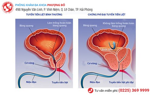 Hình ảnh tuyến tiền liệt phì đại