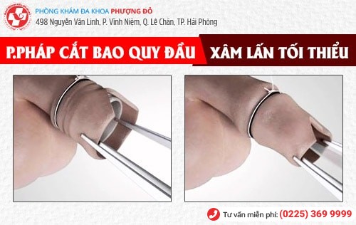 Địa chỉ cắt bao quy đầu uy tín ở Hải Phòng