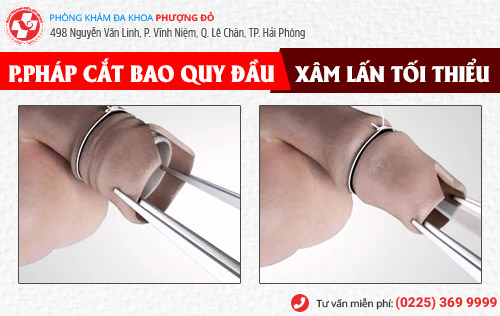 phương pháp cắt bao quy đầu