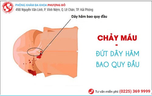 Quan hệ bị chảy máu do đứt dây hãm bao quy đầu