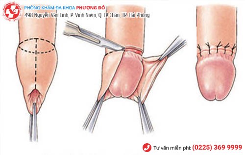 quy trình cắt bao quy đầu