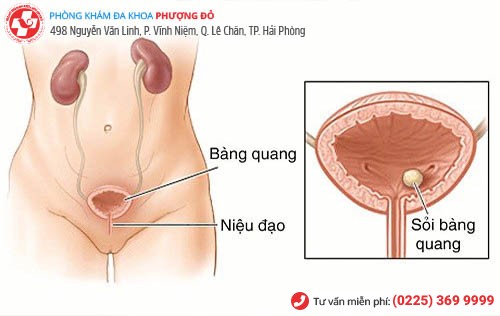 bệnh sỏi bàng quang