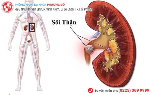 Sỏi thận khiến người bệnh đi tiểu ra máu