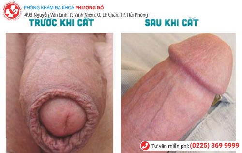 Súyt mất của quý vì tự cắt bao quy đầu tại nhà