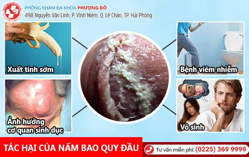 Nấm bao quy đầu – Khốn khổ vì ngứa rát mọi nơi mọi lúc