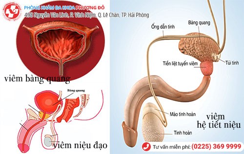 tiểu buốt là dấu hiệu bệnh gì