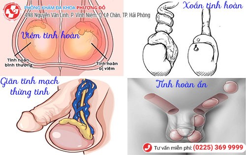 Tinh hoàn không đều do nhiều nguyên nhân gây nên