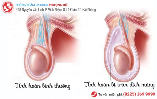 tràn dịch màng tinh hoàn