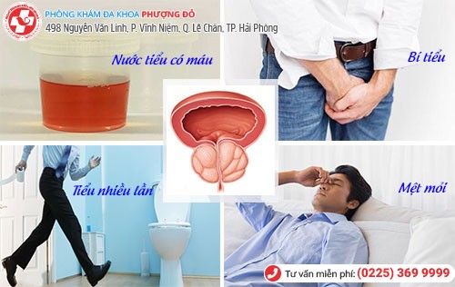 Triệu chứng phì đại tuyến tiền liệt