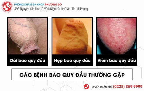 phòng khám cắt bao quy đầu