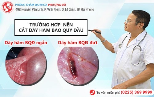 Nên cắt dây hãm quy đầu khi nào? Giải đáp chi tiết bác sĩ chuyên khoa