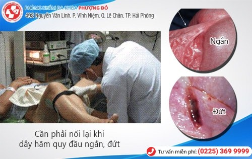 Trường hợp nào cần nối dây hãm quy đầu? Phương pháp nối dây hãm an toàn