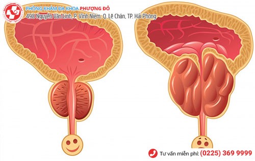 U xơ tuyến tiền liệt do viêm