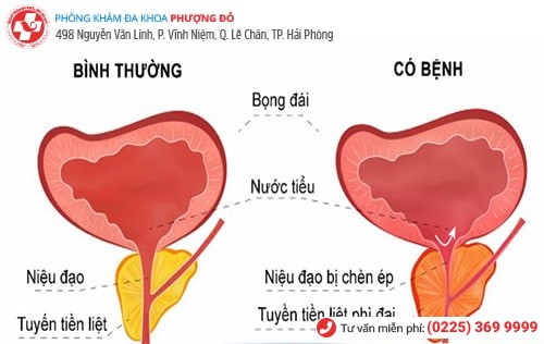 Hình ảnh tuyến tiền liệt u xơ