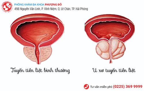 Biểu hiện u xơ tuyến tiền liệt