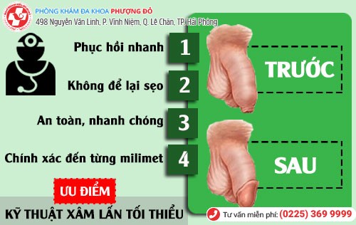 Ưu điểm cắt bao quy đầu