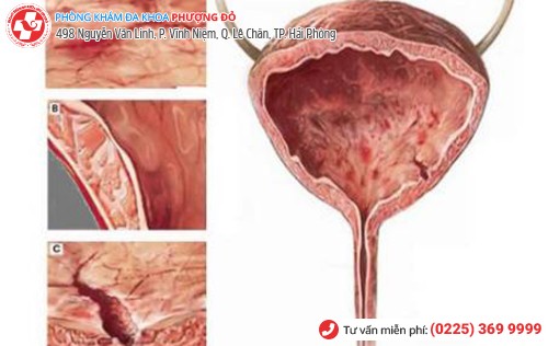 Viêm bàng quang mãn tính khiến người bệnh đi tiểu lẫn máu