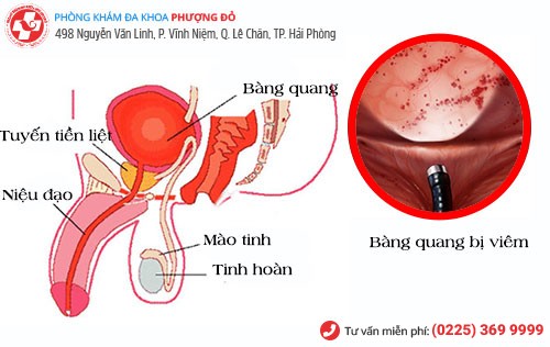 viêm bàng quang cấp 