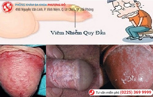 Hình ảnh viêm bao quy đầu