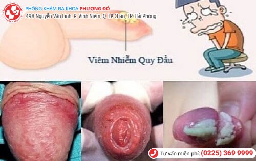 Xuất hiện bợn trắng do viêm bao quy đầu