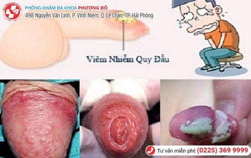 Hình ảnh viêm bao quy đầu