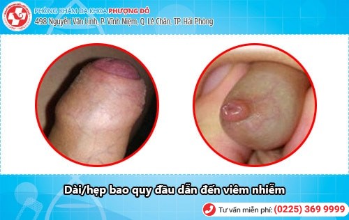 Hình ảnh viêm bao quy đầu. Viêm bao quy đầu có nguy hiểm không?