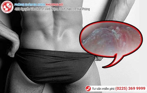 Viêm bao quy đầu là gì? Giải đáp chi tiết từ bác sĩ chuyên khoa