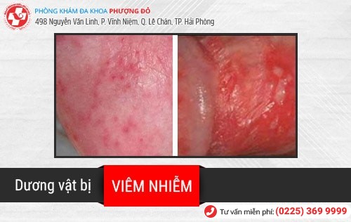 Viêm dương vật là gì? Điều trị bằng phương pháp nào hiệu quả?