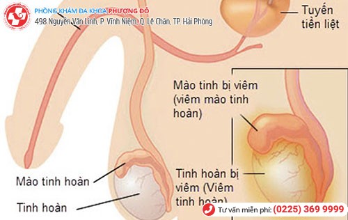 biểu hiện viêm mào tinh