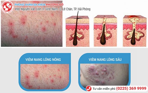 biểu hiện viêm nang lông