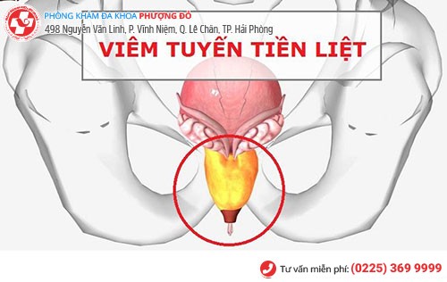 Hình ảnh tuyến tiền liệt bị viêm