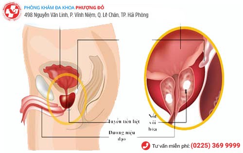 biểu hiện vôi hóa tuyến tiền liệt