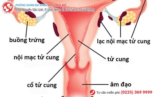 Lạc nội mạc tử cung khiến chị em đối diện những cơn đau ở bụng dưới