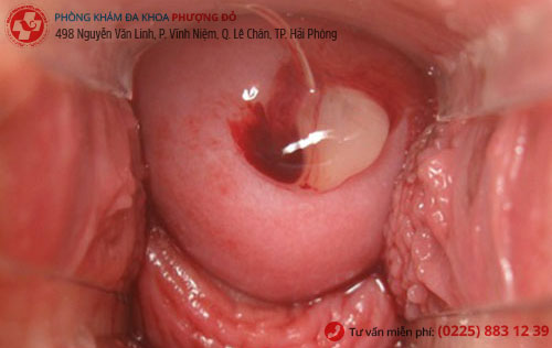 Hình ảnh Polyp cổ tử cung