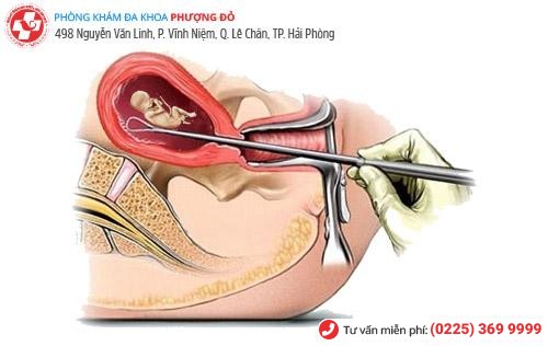 Bảng giá cho phương pháp nạo thai an toàn