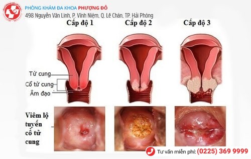 Nhận biết bệnh qua hiện tượng khí hư trắng đục