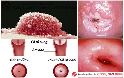 Mắc bệnh cổ tử cung tăng nguy cơ viêm phần phụ