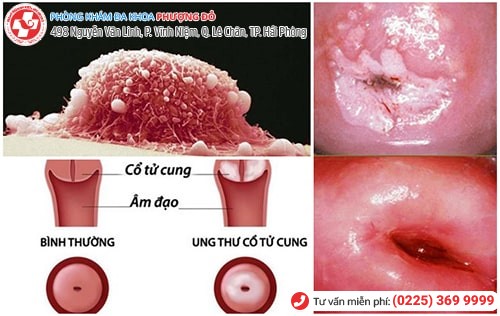 Viêm cổ tử cung có thể gây ung thư nếu bệnh tái lại nhiều lần