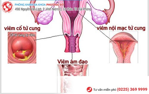 Biểu hiện của một số bệnh phụ khoa điển hình